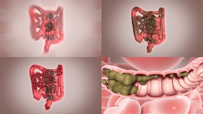 宿便 胃肠疾病 肠道 便秘