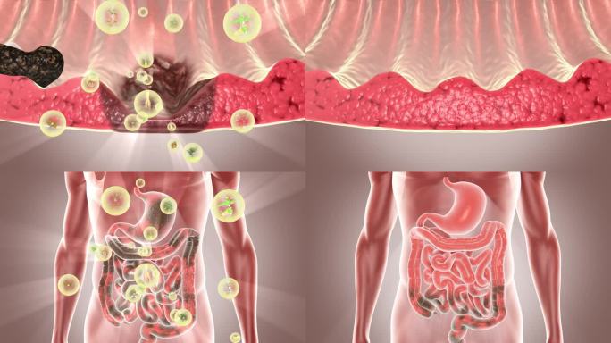 胃溃疡 修复胃溃疡 修复胃粘膜 消化系统