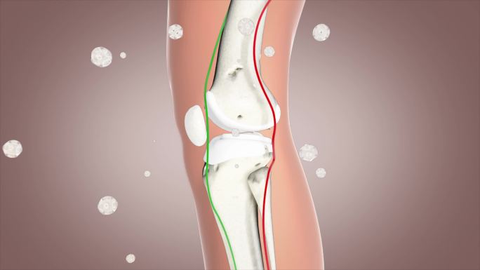 氨糖流失 关节炎 软骨软组织 腿关节腿痛