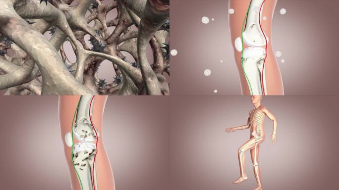 氨糖流失 关节炎 软骨软组织 腿关节腿痛