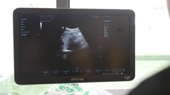 胃镜超生影像分析胃镜胸腔透析医疗检查B超