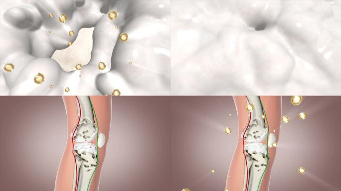 AE修复软骨 关节炎软骨 软组织腿关节