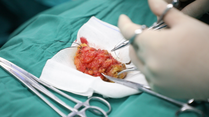 乳腺手术全流程