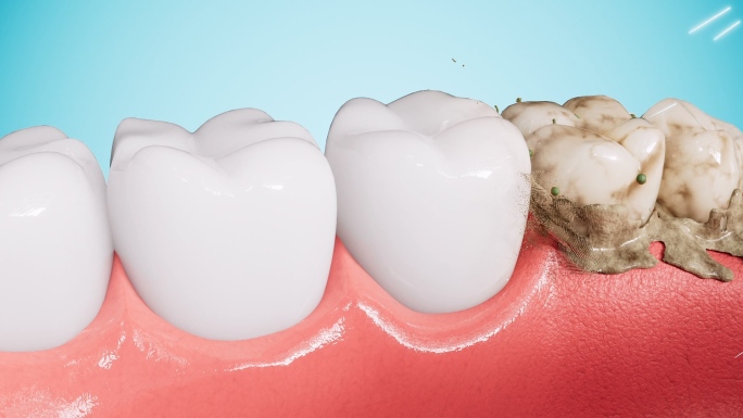 牙齿清洁去除牙菌斑
