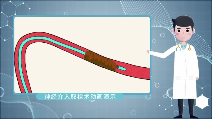 神经介入取栓术mg动画