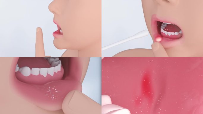 口腔溃疡 细胞毒素 溃疡破损 堆积愈合