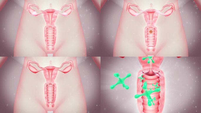 阴道病毒细菌 女性生殖系统 粘膜敏感