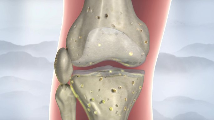 人体 风湿 关节炎 骨关节 疾病 滋养