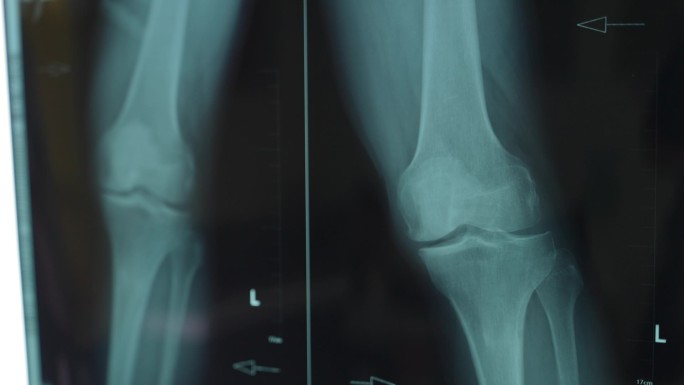 骨科专家看诊膝关节影像照片分析