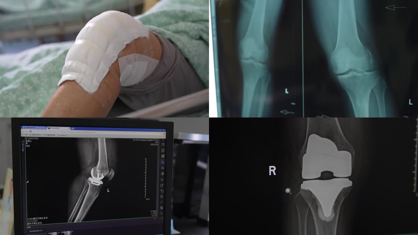 骨科专家看诊膝关节影像照片分析