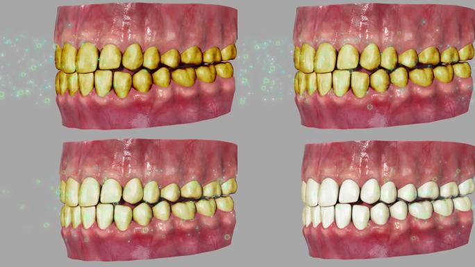 口腔清洁3D动画牙齿黄变白洁牙清新口气