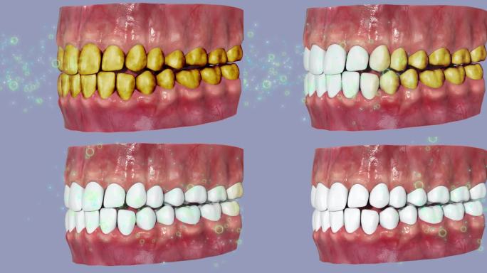 洁牙三维动画白净牙齿3D模型口腔清洁病理