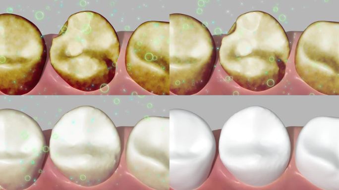 牙齿修复3D动画口腔病理恢复补牙缺口