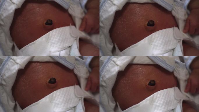 新生儿 新生儿肚子特写 脐带 脐带脱落