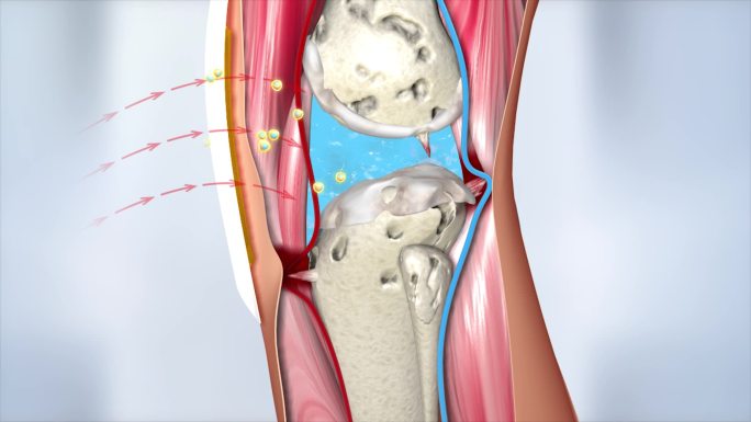 关节炎 软骨 软组织 腿关节