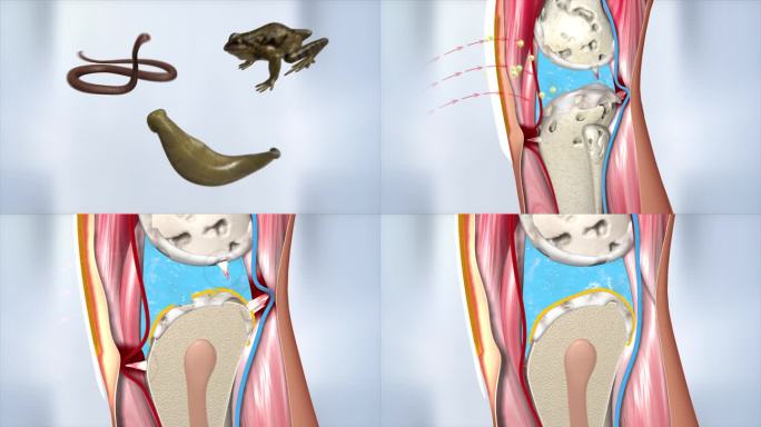 关节炎 软骨 软组织 腿关节