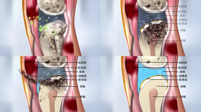 关节 炎症消除 淤血 修复 膝 滑膜