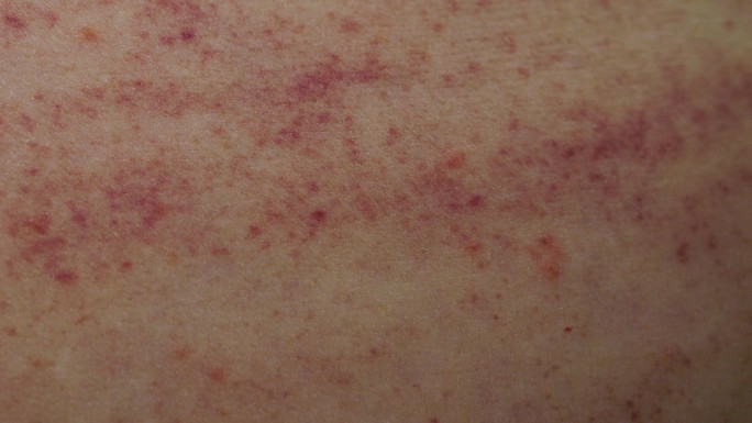 接触性皮肤过敏昆虫性皮炎花粉性皮肤过敏