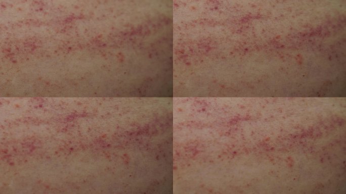 接触性皮肤过敏昆虫性皮炎花粉性皮肤过敏