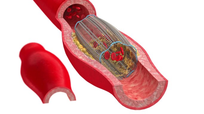 动脉血管支架手术