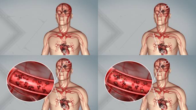 心脑堵塞 心脑血管血栓