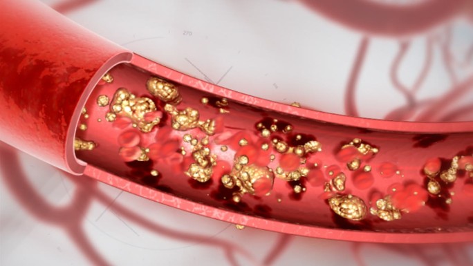 人体血液 血管 血管堵塞 粥样硬化