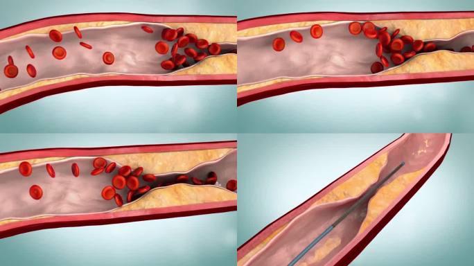 血管闭塞和支架插入