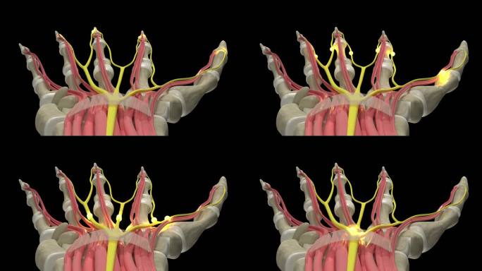 腕管综合征3D动画