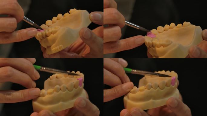 牙齿制作过程假牙义齿
