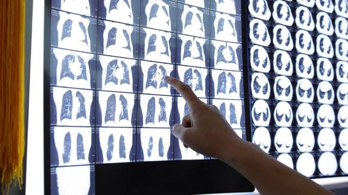 胸部CT  病情分析 诊断 x光片 会诊