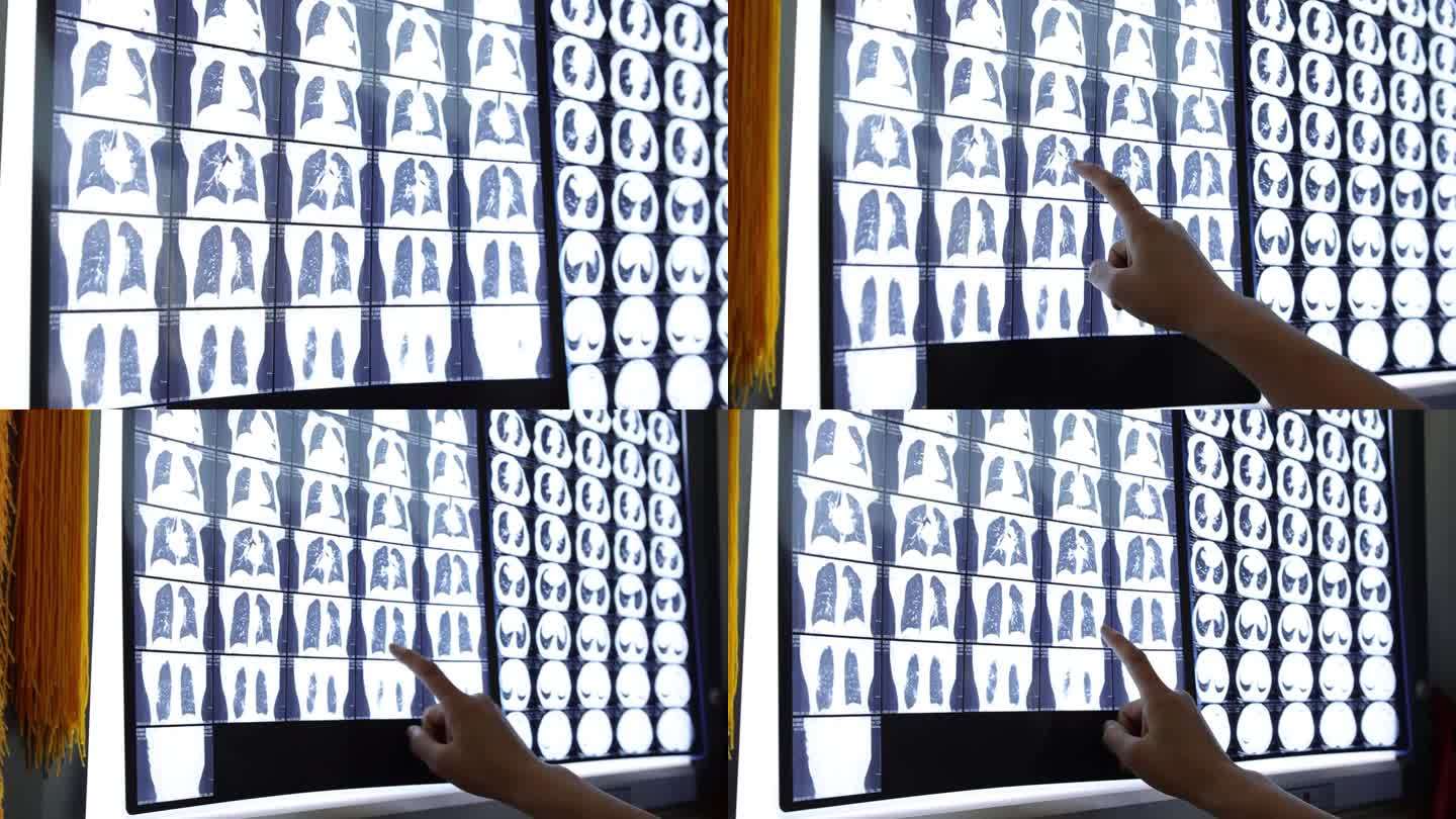 胸部CT  病情分析 诊断 x光片 会诊