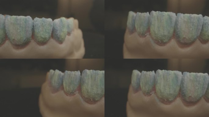 牙齿制作过程假牙义齿口腔