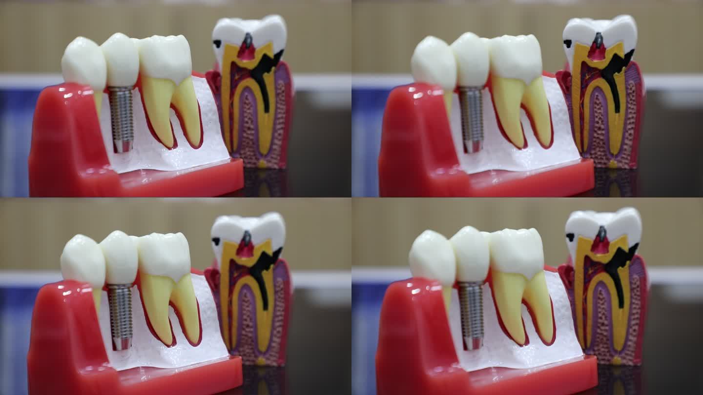 口腔 医疗 种植牙 牙冠 模型展示