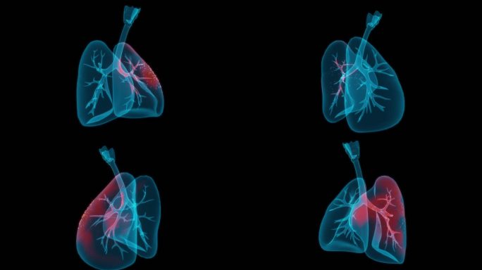 肺部感染 肺炎肺结核肺病肺癌炎症扩散结节