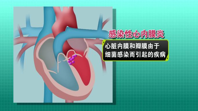 医学动画：心内膜炎