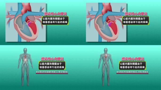 医学动画：心内膜炎