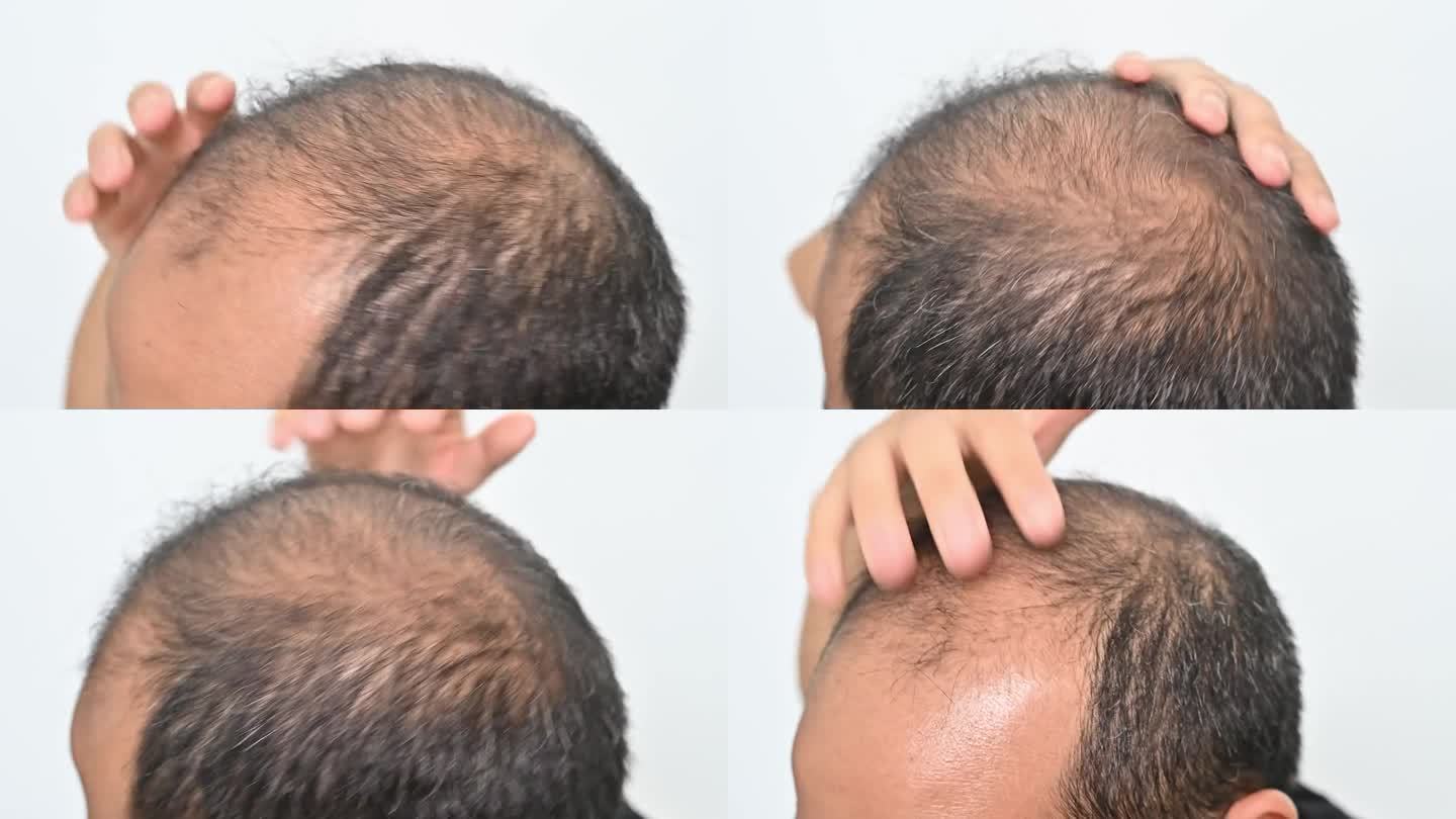 不自信的亚洲秃顶男子摸自己的头导致脱发问题。