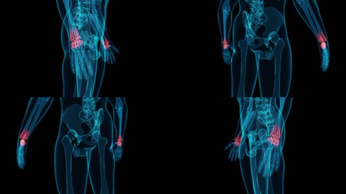 手腕 腱鞘炎手掌手臂手肘左手右手骨科骨头