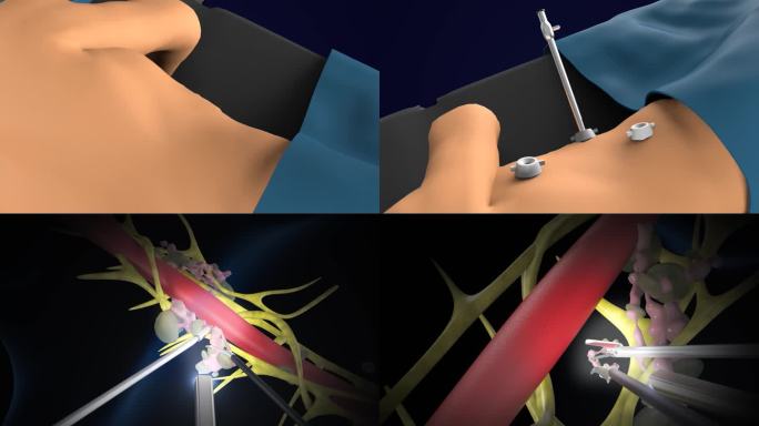 食道癌手术流程3D动画