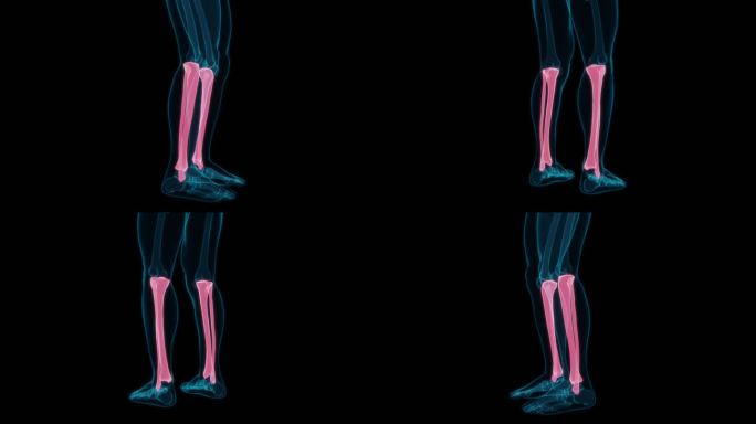 大腿骨 胫骨风湿病半月板骨折骨科骨头腿部