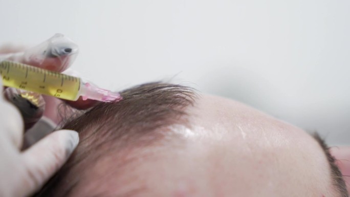 现代美容诊所头发美容过程的微距镜头，血浆注射。中年男性患者毛发再生prp手术