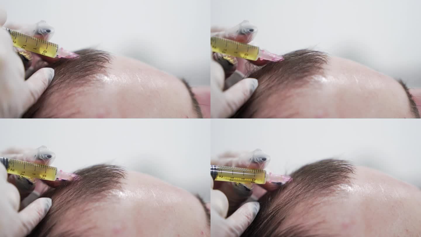 现代美容诊所头发美容过程的微距镜头，血浆注射。中年男性患者毛发再生prp手术