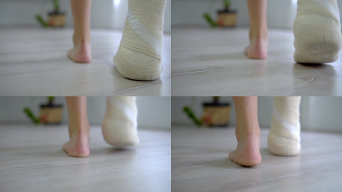 腿伤后在家中进行康复治疗，一名打石膏的脚骨折妇女试图迈出一小步