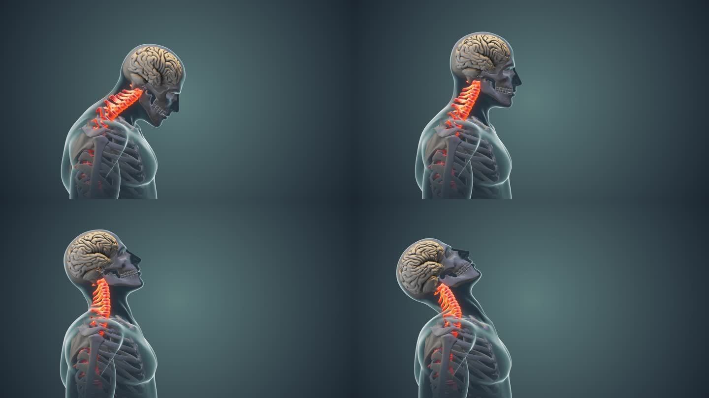 颈部疼痛或颈椎姿势综合征的医学动画