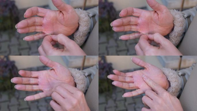 一个年轻的女人搔痒她的手掌脱皮。