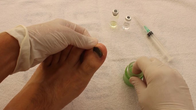 皮肤科医生用草药膏治疗脚后跟刺和脚癣。血脚趾甲治疗。