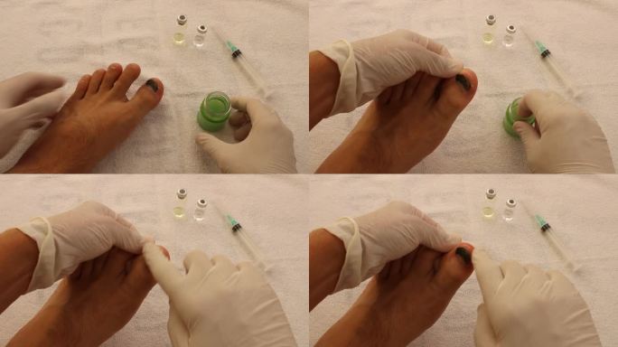 皮肤科医生用草药膏治疗脚后跟刺和脚癣。血脚趾甲治疗。