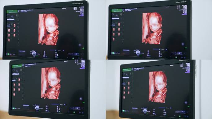 超声仪监视器上胎儿在母体子宫内的图像。在超声波设备上检查婴儿发育情况。关闭了。