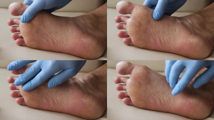 男性足部皮肤干燥，足部牛皮癣皮肤受损。皮炎、湿疹、牛皮癣、过敏反应。诊断脱皮和裂缝的人的腿。真菌感染