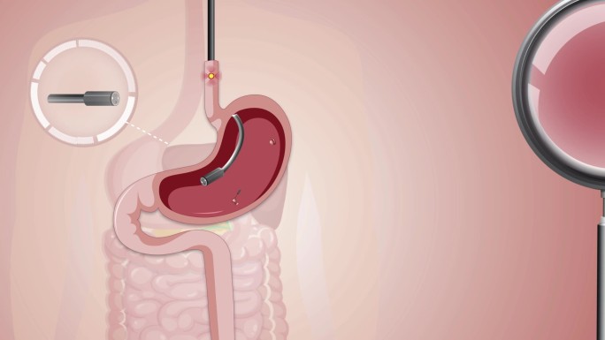 MG肠胃镜——工作原理的构成演示动画